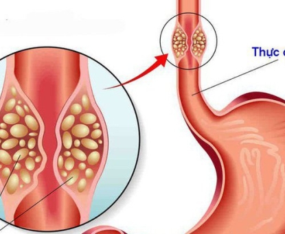 Tổng quan về ung thư thực quản 